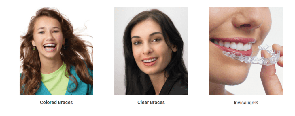 Types of braces