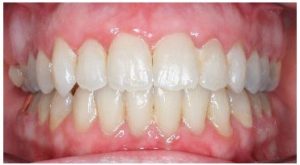 After orthodontics