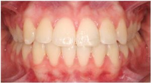After orthodontics