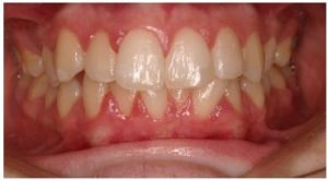 Before orthodontics